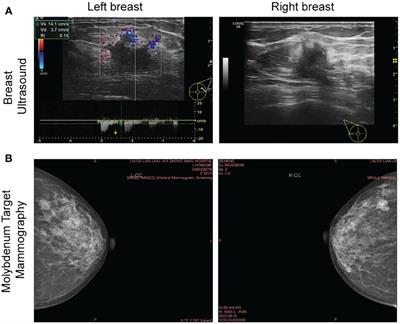 Patient-derived organoid elucidates the identical clonal origin of bilateral breast cancer with diverse molecular subtypes